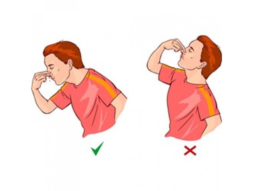 How to Treat a Nosebleed
