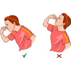 How to Treat a Nosebleed